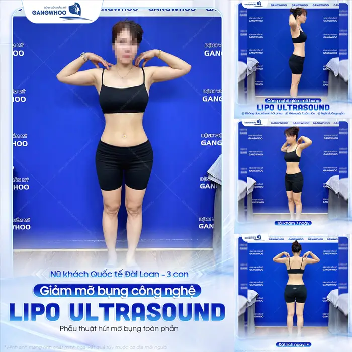 Giảm mỡ bụng công nghệ Lipo Ultrasound tự tin khoe vòng eo thon gọn khi tái khám
