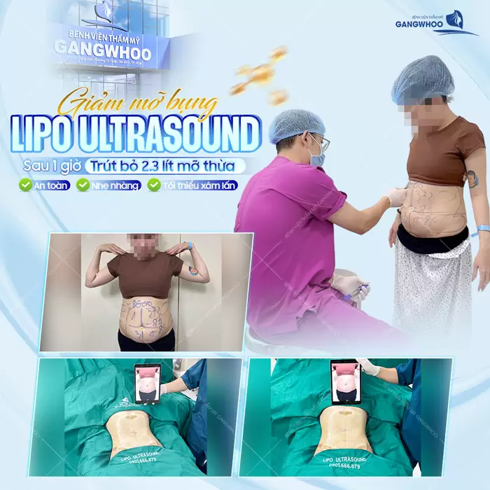 Giảm mỡ bụng công nghệ (Lipo Ultrasound) trút bỏ mỡ thừa hiệu quả, an toàn và nhẹ nhàng
