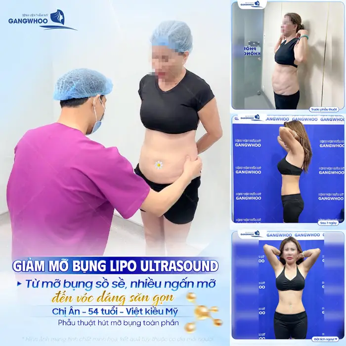Giảm mỡ bụng Lipo Ultrasound từ bụng mỡ sồ sề đến vóc dáng đẹp săn gọn cho chị khách Việt Kiều