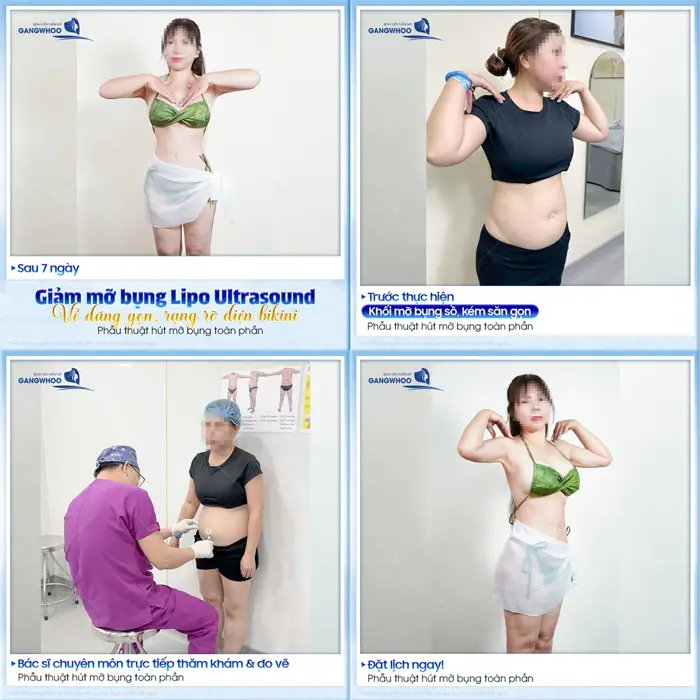 Giảm mỡ bụng Lipo Ultrasound vóc dáng thon gọn, rạng rỡ diện bikini đón hè cực cháy