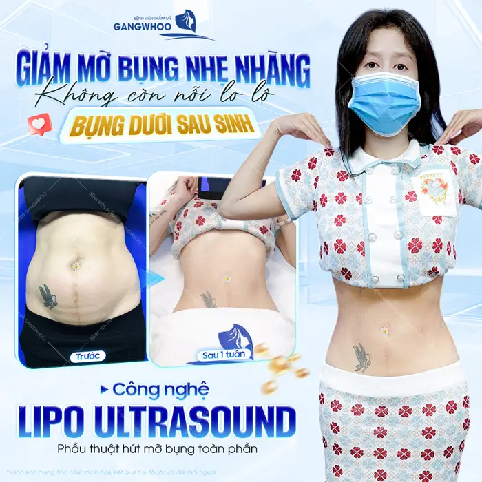 Giảm mỡ bụng nhẹ nhàng không còn là nỗi lo bụng dưới sau sinh với công nghệ giảm mỡ Lipo Ultrasound hiện đại 