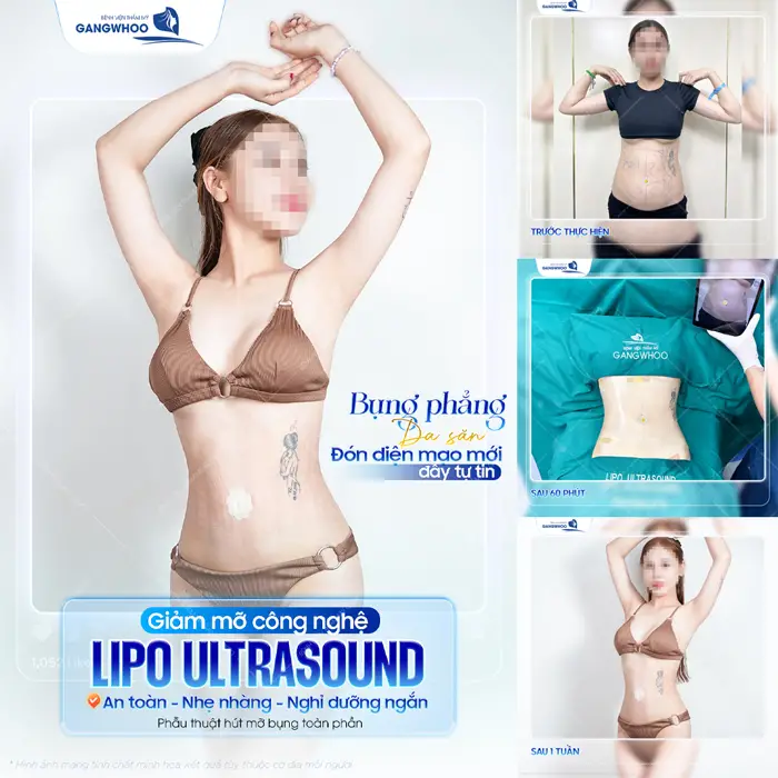 Giảm mỡ công nghệ Lipo Ultrasound an toàn, nhẹ nhàng và nghỉ dưỡng ngắn 