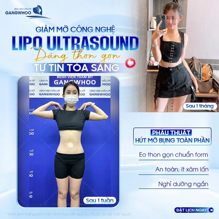 Giảm mỡ Lipo Ultrasound dáng thon gọn tự tin tỏa sáng sau 1 tháng đã tự tin diện đồ khoe eo thon nuột 