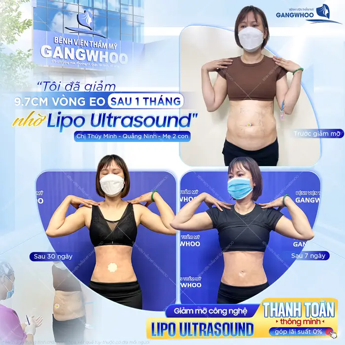 Hút Mỡ Bụng Sau Bao Lâu Thì Đẹp? Cách Chăm Sóc Nhanh Đẹp 3 Giảm mỡ bụng (Lipo Ultrasound) thành công sau 1 tháng đã lấy lại vòng eo con kiến