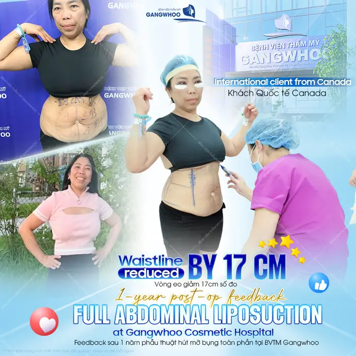 Tạm biệt ngay 17 cm số đo sau giảm mỡ thừa hiệu quả ngay sau 1 lần can thiệp hút mỡ bụng Lipo Ultrasound