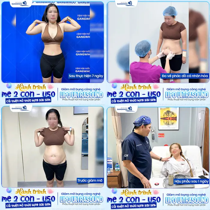 Hút Mỡ Xong Có Béo Lại Không? Chuyên Gia Giải Đáp 1 Hành trình giảm mỡ thành công vượt ngoài sức tưởng tượng của mẹ bỉm 2 con