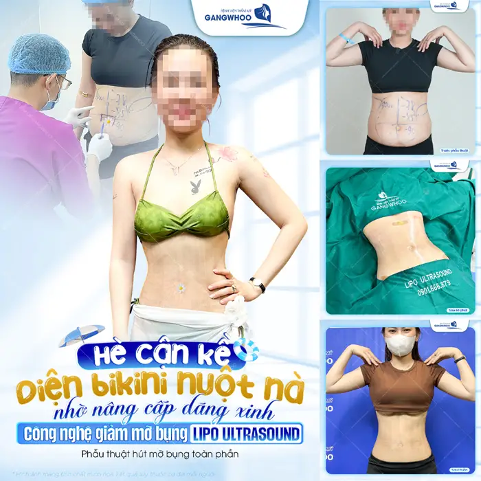 Hè cận kề diện bikini nuột nà nhờ nâng cấp dáng xinh với công nghệ giảm mỡ bụng Lipo Ultrasound
