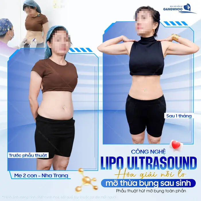 Giảm mỡ công nghệ Lipo Ultrasound hóa giải nỗi lo mờ thừa sau sinh hiệu quả của mẹ bỉm đến từ Nha Trang