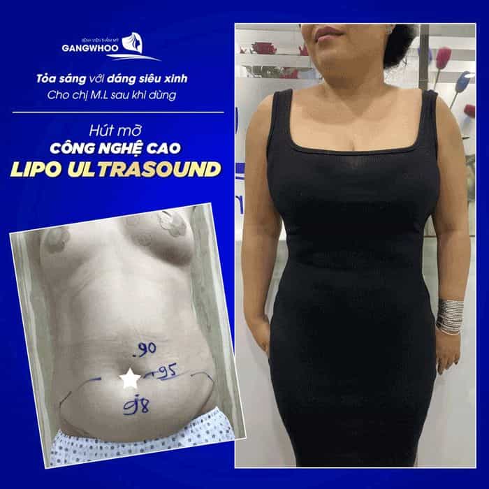 IMAGES OF OUR CUSTOMERS BEFORE & AFTER LIPOSUCTION AT GANGWHOO COSMETIC HOSPITAL