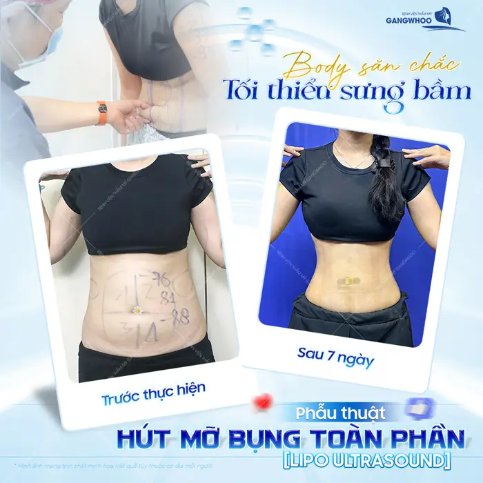 Phẫu thuật hút mỡ bụng toàn phần body săn chắc tối thiểu sưng bầm sau 7 ngày thực hiện 