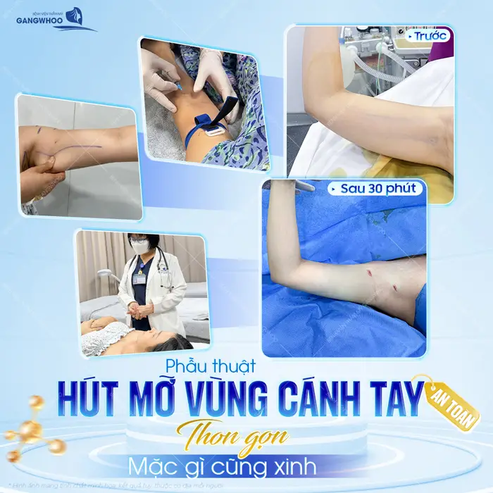 Hút mỡ vùng cánh tay giải pháp hoàn hảo cho đôi tay thon gọn, mềm mại, an toàn và đẹp dài lâu 