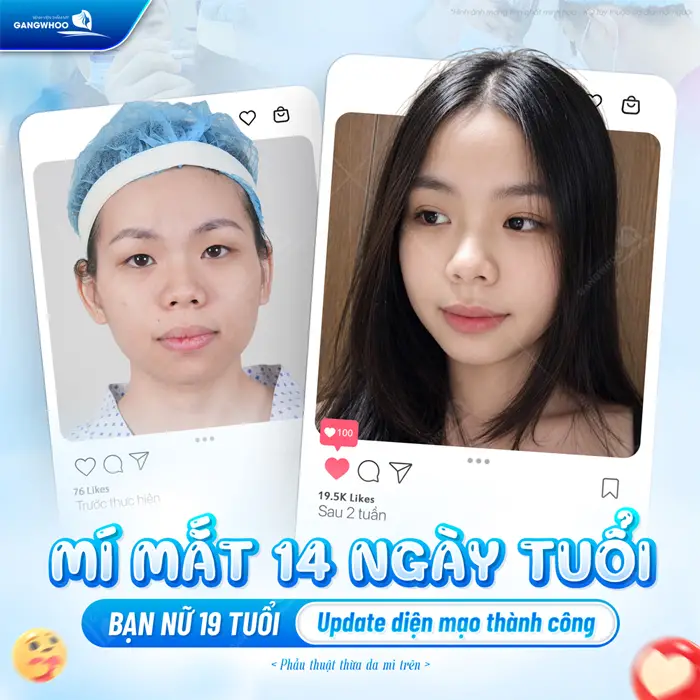 Mí mắt sau 14 ngày tuổi update thành công diện mạo và nhan sắc ngày càng xinh đẹp và trẻ trung