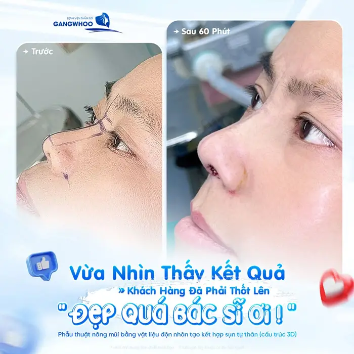 Nâng Mũi An Toàn Tại Bệnh Viện Thẩm Mỹ Gangwhoo 2 Kết quả vừa hoàn thành sau nâng mũi đã đẹp xuất sắc