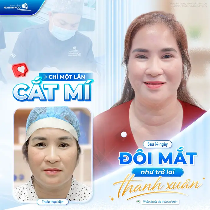 Cắt Mí Rồi Có Cắt Lại Được Không? Địa Chỉ Cắt Mí Lần 2 1 Sau 14 ngày đôi mắt trở lại như thanh xuân chri 1 lần cắt mí gương mặt đẹp bừng sáng