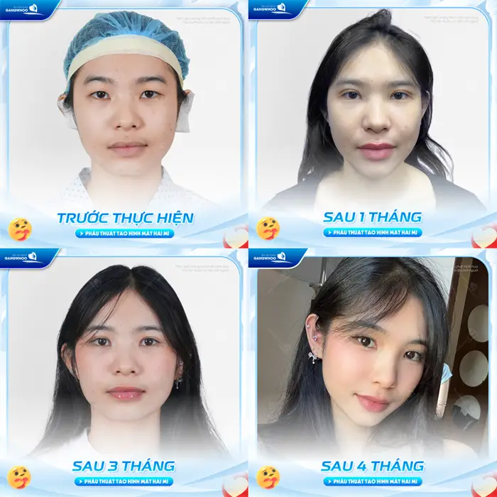 Kết quả sau 4 tháng cắt mí mắt vào form đẹp chuẩn mềm mại, tự nhiên và hài hòa hơn với diện mạo khuôn mặt