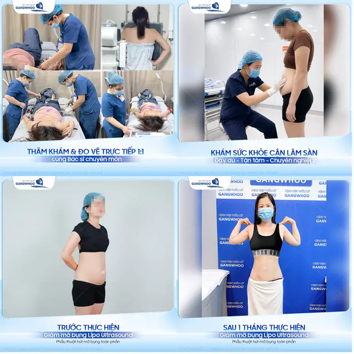 Giảm mỡ bụng Lipo Ultrasound đúng quy trình eo thon phẳng nuột chỉ còn là chuyện nhỏ