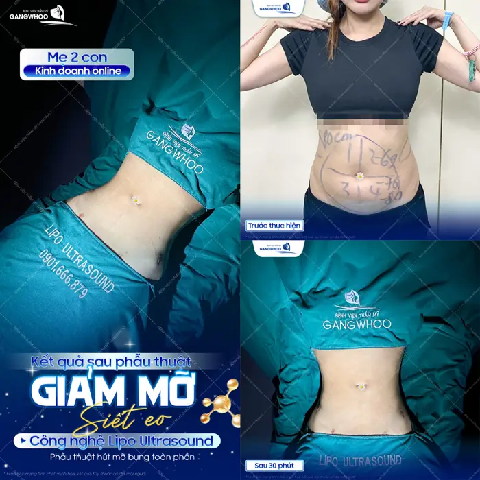 Hút Mỡ Bụng Kiêng Quan Hệ Bao Lâu? 5 Cách Chăm Sóc 4 Kết quả sau phẫu thuật giảm mỡ siết eo công nghệ Lipo Ultrasound eo thon bụng phẳng ngay sau thực hiện