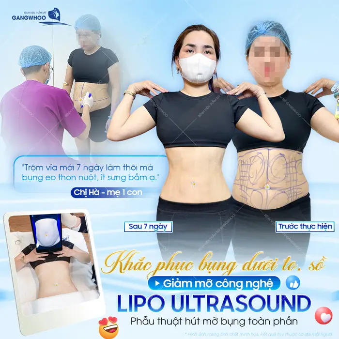 Khắc phục bụng dưới to, sồ giảm mỡ công nghệ Lipo Ultrasound mẹ 1 con sau 7 ngày đã tự tin khoe eo thon phẳng nuột 