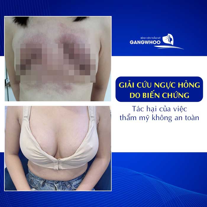 Breast Revision - Gangwhoo Cosmetic Hospital's Korean Technology