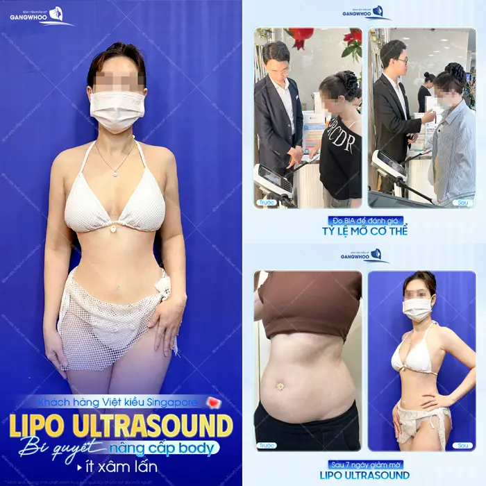 Nâng cấp body đẹp siêu cuốn hút an toàn và ít xâm lấn sau 7 ngày giảm mỡ (Lipo Ultrasound)