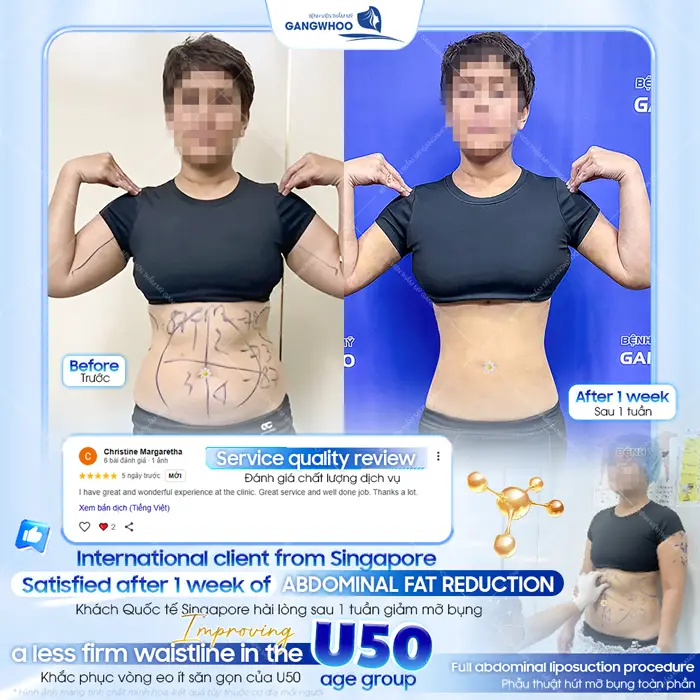 Khách quốc tế đến từ Singapore sau 1 tuần giảm mỡ đã bày tỏ sự hài lòng về kết quả và chất lượng dịch vụ 