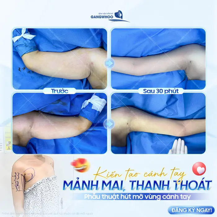 Phẫu thuật hút mỡ vùng cánh tay kiến tạo cánh tay thon gọn, mảnh mai và thanh thoát