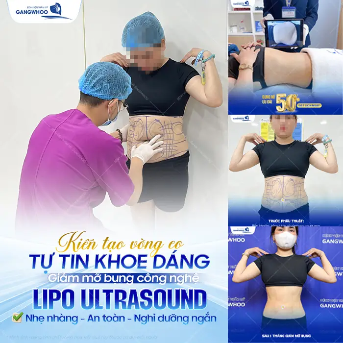 Kiến tạo vòng eo con kiến tự tin khoe dáng đẹp nuột nà với công nghệ Lipo Ultrasound hiện đại 