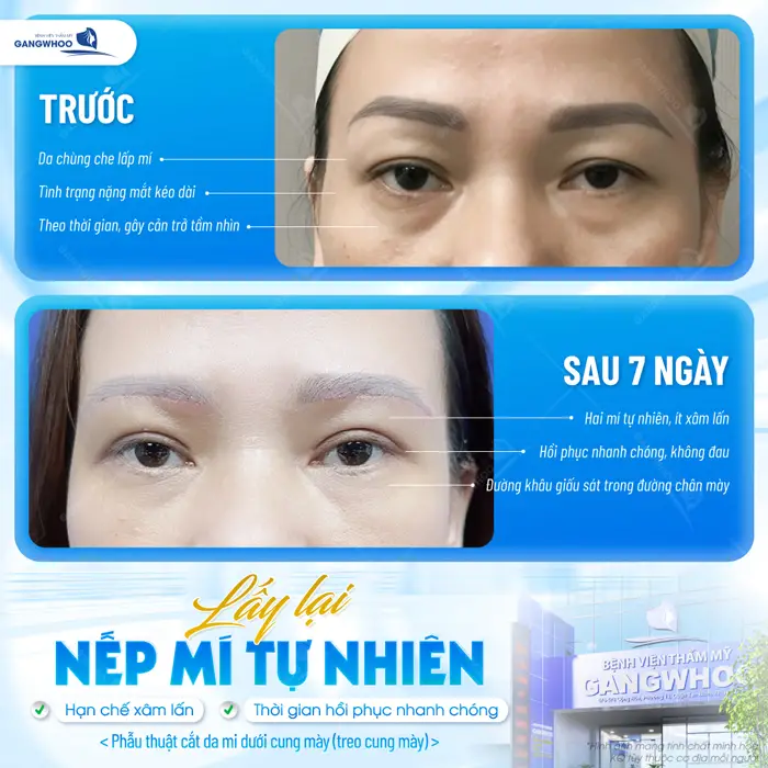 Lấy lại nếp mí tự nhiên an toàn và hạn chế xâm lấn mắt đẹp, hài hòa và nhanh hồi phục 
