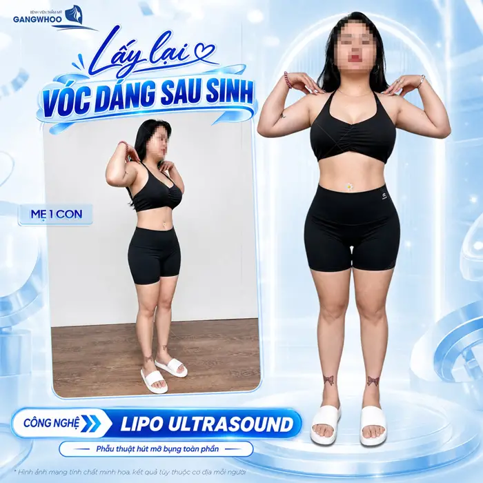 Hút Mỡ Bụng Có Đau Không? Cách Giảm Đau Sau Khi Hút Mỡ 4 Lấy lại vóc dáng sai sinh nhờ ứng dụng công nghệ Lipo Ultrasound hiện đại