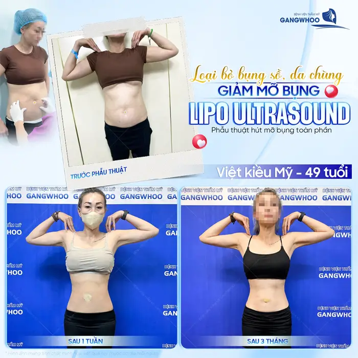 Loại bỏ bụng sồ, da chùng sau giảm mỡ bụng ứng dụng công nghệ Lipo Ultrasound hiện đại