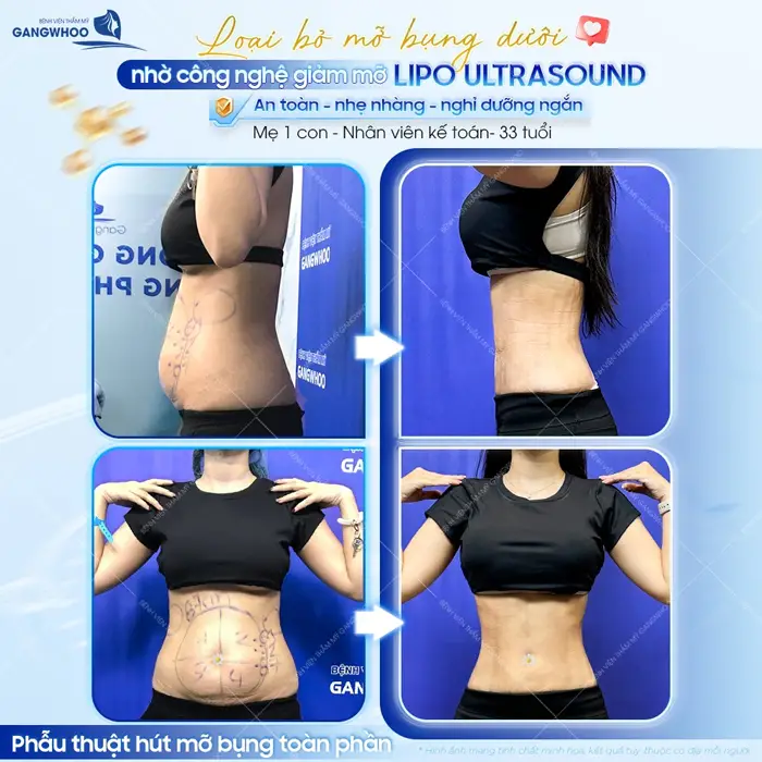 Loại bỏ mỡ bụng dưới nhờ công nghệ giảm mỡ Lipo Ultrasound an toàn và nhẹ nhàng cho mẹ 1 con 