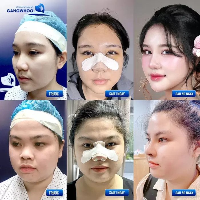 Lựa chọn dáng mũi phù hợp với khuôn mặt sẽ giúp duy trì kết quả nâng mũi bền đẹp dài lâu