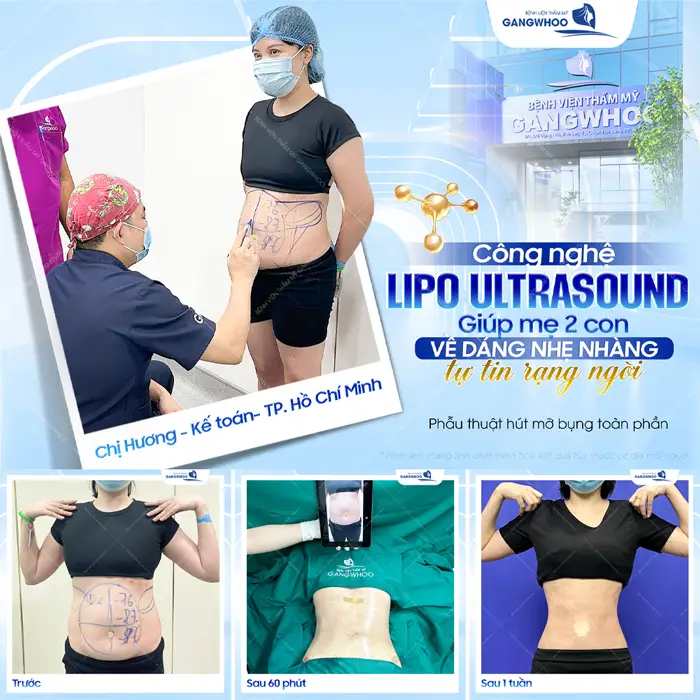 Công nghệ giảm mỡ Lipo Ultrasound giúp mẹ 2 con về lại dáng nhẹ nhàng, tự tin và rạng rỡ