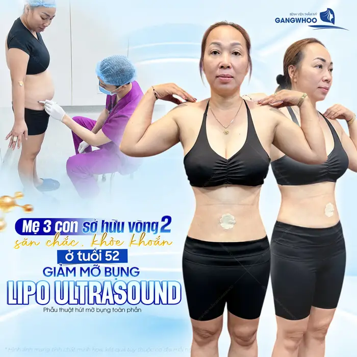 Mẹ 3 con sở hữu vòng 2 săn chắc khỏe khoắn ở độ tuổi 52 sau giảm mỡ bụng Lipo Ultrasound
