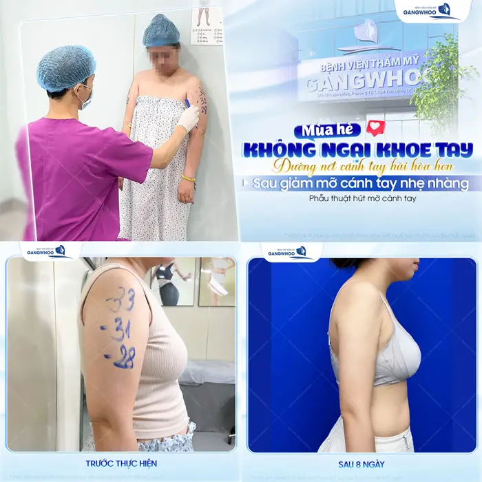 Hút Mỡ Bắp Tay Kiêng Ăn Gì Để Mau Hồi Phục, Nhanh Đẹp? 3 Mùa hè không ngại khoe tay vì đường nét cánh tay đẹp thon, hài hòa sau công nghệ giảm mỡ