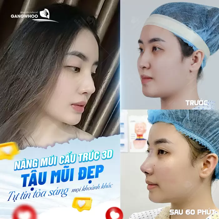 Nâng mũi tại Gangwhoo lựa chọn hoàn hảo để cải thiện nhan sắc thêm sắc nét và tỏa sáng