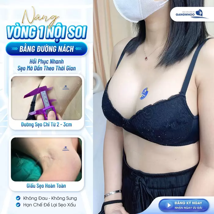 Sẹo Nâng Ngực Có Đáng Lo Ngại Không? Cách Ngừa Sẹo Nâng Ngực 3 Nâng vòng 1 nội soi đường nach hồi phục nhanh sẹo mờ dần theo thời gian