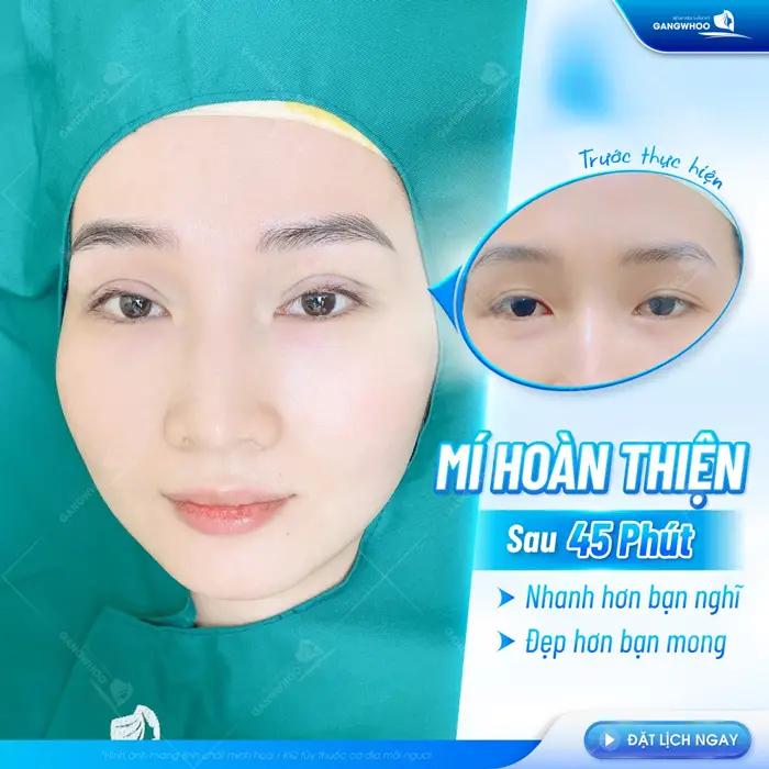 Nếp mí đẹp hoàn thiện sau 45 phút thực hiện mí đẹp mí xinh 