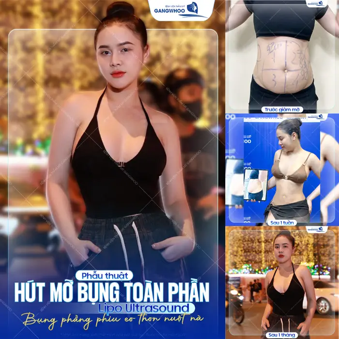 Phẫu thuật hút mỡ bụng toàn phần bụng phẳng phiu eo thon gọn thấy rõ sự cải thiên chỉ sau 1 tháng thực hiện