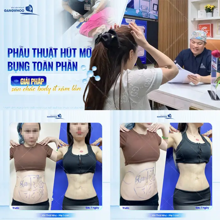 Phẫu thuật hút mỡ bụng toàn phần giải pháp hoàn hảo cho đường cong đẹp phẳng mịn và an toàn dài lâu 