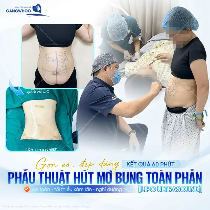 Phẫu thuật hút mỡ bụng toàn phần eo gọn, dáng xinh kết quả đã hoàn toàn khác biệt sau 60 phút