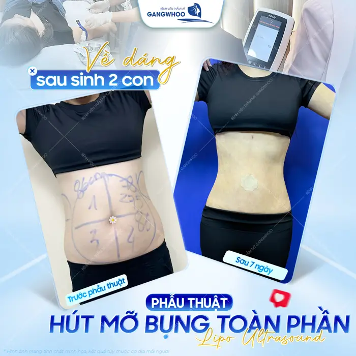 Phẫu thuật hút mỡ bụng toàn phần sự cải thiện khác biệt thấy rõ sau 7 ngày thực hiện 