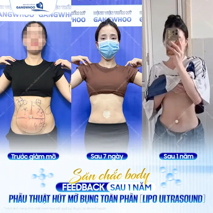 Hút Mỡ Bụng Sau Bao Lâu Thì Đẹp? Cách Chăm Sóc Nhanh Đẹp 1 Phẫu thuật hút mỡ bụng toàn phần Lipo Ultrasound kết quả cải thiện thấy rõ từng ngày