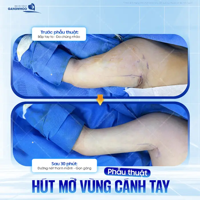 Phẫu thuật hút mỡ cánh tay đường nét thanh mảnh gọn gàng và thay đổi rõ rệt sau phẫu thuật 