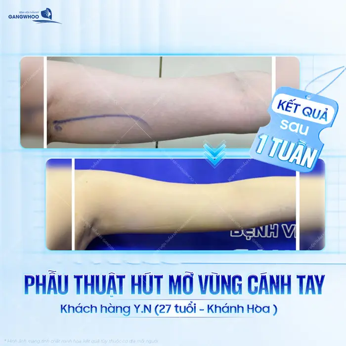 Phẫu thuật hút mỡ vùng cánh tay kết quả thay đổi rõ rệt sau 1 tuần thực hiện