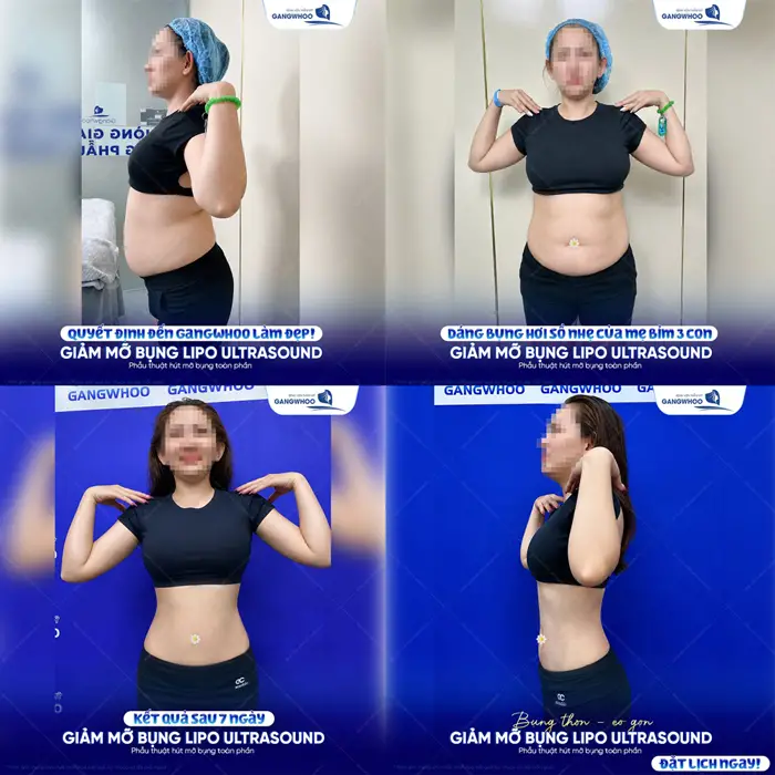 Quyết định đến Gangwhoo làm đẹp giảm mỡ bụng Lipo Ultrasound kết quả sau 7 ngày giảm mỡ đã hoàn toàn khác biệt