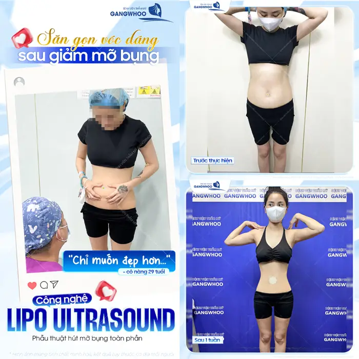 Hút Mỡ Bụng Sau Bao Lâu Thì Đẹp? Cách Chăm Sóc Nhanh Đẹp 2 Sắc vóc thon gọn sau giảm mỡ bụng công nghệ Lipo Ultrasound sau 1 tuần đã đẹp hơn, thon gọn hơn