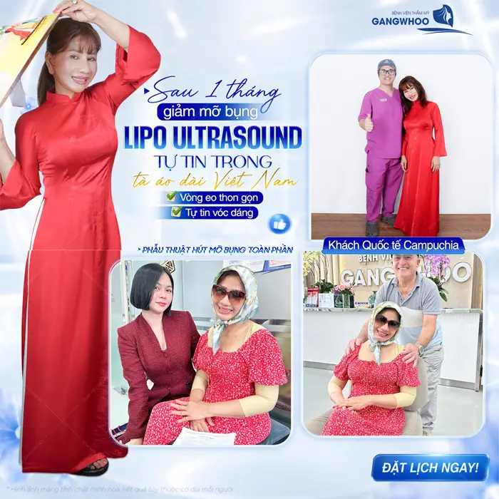 Sau 1 tháng giảm mỡ bụng công nghệ Lipo Ultrasound tự tin tà áo dài Việt Nam sau lần tái khám
