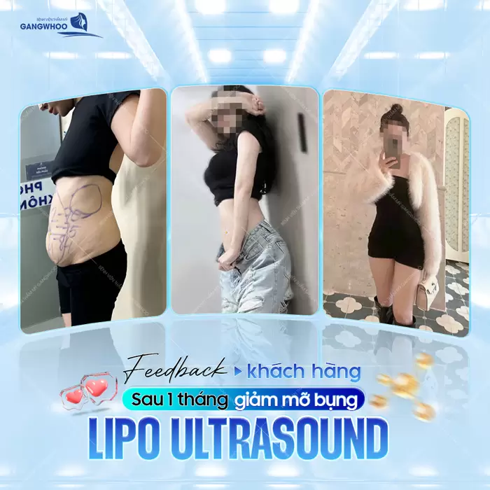 Sau 1 tháng hút mỡ bụng công nghệ (Lipo Ultrasound) sắc vóc trở lại thời sắc son ai nhìn cũng không nhận ra