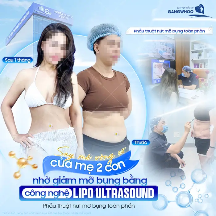 Hút Mỡ Bụng Sau Bao Lâu Thì Đẹp? Cách Chăm Sóc Nhanh Đẹp 2 Vòng eo đẹp chuẩn người mê của mẹ bỉm 2 con nhờ công nghệ giảm mỡ Lipo Ultrasound hiện đại